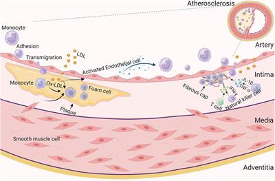 Immune cell-mediated features of atherosclerosis